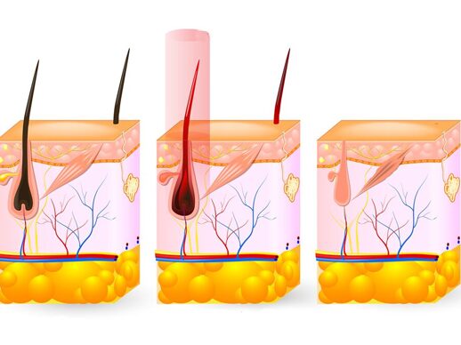  Что такое лазерная эпиляция и как она работает 